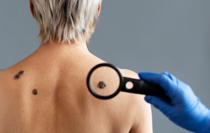 señales de un cáncer de piel